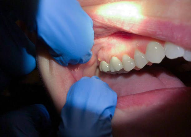 Best Emergency Broken Tooth Repair in Trappe, MD